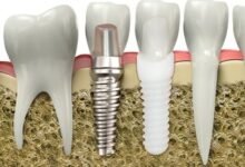 Long-Term Advantages of Choosing Dental Implants in Manchester The decision to invest in dental implants can be an impactful one, affecting an individual's life in a multitude of ways. One city that particularly stands out for its dental implant services is Manchester. Dental implants Manchester are not just a fleeting trend, but a long-term solution for those who want the best for their oral health. These implants are designed to last a lifetime, offering a plethora of benefits that make them an excellent choice. They provide a sturdy foundation for replacement teeth, which not only feel but look and function like natural teeth. Manchester's skilled dental professionals use state-of-the-art technology to ensure the implants are a perfect fit. Choosing dental implants in Manchester is, therefore, a worthwhile investment for anyone seeking a lasting solution to missing teeth. Introduction to Dental Implants Dental implants are a robust and reliable solution for replacing missing or damaged teeth. They consist of a titanium post that is surgically placed into the jawbone, providing a secure base for a crown or artificial tooth. The implant fuses with the bone over time, a process known as osseointegration. This fusion creates a strong and stable foundation, much like a natural tooth root, preventing the potential movement and slippage associated with traditional dentures. With a success rate of up to 98%, dental implants are increasingly becoming the first choice for tooth replacement. Furthermore, the dental professionals in Manchester offer unparalleled expertise in implantology, providing high-quality care and precision in every procedure. Durability and Longevity The durability and longevity of dental implants are among their most significant benefits, setting them apart from other tooth replacement options. Dental implants are designed to last a lifetime with proper care. Unlike dentures or bridges, which may require replacements or adjustments over time, the sturdy titanium implants provide a durable solution that withstands daily wear and tear. With the high-quality dental implant services in Manchester, you can rest assured that your implants will stand the test of time. Regular check-ups and good oral hygiene can help ensure your implants remain in excellent condition for years to come. So, for those seeking a long-lasting solution, it's worth considering dental implants in Manchester. Enhanced Aesthetic Appeal The aesthetic appeal of dental implants is undoubtedly another crucial factor contributing to their popularity. Dental implants look and feel like natural teeth, thanks to the seamless integration of the implant with the jawbone. This results in a natural-looking smile that can significantly enhance one's appearance. Additionally, dental implants prevent the facial sagging and premature ageing that can result from missing teeth, helping you maintain your youthful look. In Manchester, the dental professionals take great care in designing the prosthetic teeth, ensuring they blend in seamlessly with the rest of your teeth. With dental implants in Manchester, you can smile with confidence, knowing your teeth look natural and attractive. Improved Oral Health Dental implants also play a pivotal role in promoting overall oral health. They preserve the jawbone, preventing the bone loss that can occur when teeth are missing. Moreover, they don't require grinding down adjacent teeth as traditional bridges do, which helps protect your natural teeth. Dental implants also eliminate the need for removable dentures, allowing for easier eating and speaking. This contributes to improved digestion and communication, further enhancing quality of life. In Manchester, dental professionals adhere to the highest standards of sanitation and hygiene during the implant procedures, minimising the risk of infection. Opting for dental implants in Manchester is a step towards improved oral health and a healthier lifestyle overall. Boosted Confidence and Self-Esteem A bright, healthy smile can do wonders for one's confidence and self-esteem, and dental implants play a significant role in achieving this. Dental implants in Manchester offer a sense of security and comfort, as they don't slip or move around like traditional dentures can. This stability allows for clear speech and the freedom to enjoy all types of food without worry, which can greatly enhance one's social experience and self-confidence. The implants also provide a natural look and feel, offering an attractive smile that elevates self-esteem. For many, dental implants in Manchester have been a life-changing investment, transforming not only their smiles but also their overall confidence. Cost-Effectiveness in the Long Run While the initial cost of dental implants may be higher than other tooth replacement options, they prove to be cost-effective in the long run. The durability of dental implants reduces the need for replacements or adjustments, saving you significant expenses over the years. Additionally, dental implants prevent potential oral health issues associated with missing teeth, such as bone loss and shifting teeth, which could result in pricey dental procedures down the line. The dental professionals in Manchester offer affordable, high-quality dental implant services, bringing this long-term solution within reach of more people. Thus, choosing dental implants in Manchester is a wise investment for your oral health and financial future. Conclusion In conclusion, dental implants offer a sustainable, long-term solution for tooth replacement, providing numerous benefits such as durability, aesthetic appeal, improved oral health, boosted confidence, and cost-effectiveness. Choosing dental implants in Manchester ensures access to high-quality care from skilled dental professionals using state-of-the-art technology. While the initial investment may be considerable, the long-term advantages make it a worthwhile choice. So, whether you're seeking to enhance your smile, improve your oral health, or boost your confidence, dental implants in Manchester can provide a lasting solution.