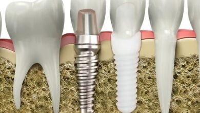 Long-Term Advantages of Choosing Dental Implants in Manchester The decision to invest in dental implants can be an impactful one, affecting an individual's life in a multitude of ways. One city that particularly stands out for its dental implant services is Manchester. Dental implants Manchester are not just a fleeting trend, but a long-term solution for those who want the best for their oral health. These implants are designed to last a lifetime, offering a plethora of benefits that make them an excellent choice. They provide a sturdy foundation for replacement teeth, which not only feel but look and function like natural teeth. Manchester's skilled dental professionals use state-of-the-art technology to ensure the implants are a perfect fit. Choosing dental implants in Manchester is, therefore, a worthwhile investment for anyone seeking a lasting solution to missing teeth. Introduction to Dental Implants Dental implants are a robust and reliable solution for replacing missing or damaged teeth. They consist of a titanium post that is surgically placed into the jawbone, providing a secure base for a crown or artificial tooth. The implant fuses with the bone over time, a process known as osseointegration. This fusion creates a strong and stable foundation, much like a natural tooth root, preventing the potential movement and slippage associated with traditional dentures. With a success rate of up to 98%, dental implants are increasingly becoming the first choice for tooth replacement. Furthermore, the dental professionals in Manchester offer unparalleled expertise in implantology, providing high-quality care and precision in every procedure. Durability and Longevity The durability and longevity of dental implants are among their most significant benefits, setting them apart from other tooth replacement options. Dental implants are designed to last a lifetime with proper care. Unlike dentures or bridges, which may require replacements or adjustments over time, the sturdy titanium implants provide a durable solution that withstands daily wear and tear. With the high-quality dental implant services in Manchester, you can rest assured that your implants will stand the test of time. Regular check-ups and good oral hygiene can help ensure your implants remain in excellent condition for years to come. So, for those seeking a long-lasting solution, it's worth considering dental implants in Manchester. Enhanced Aesthetic Appeal The aesthetic appeal of dental implants is undoubtedly another crucial factor contributing to their popularity. Dental implants look and feel like natural teeth, thanks to the seamless integration of the implant with the jawbone. This results in a natural-looking smile that can significantly enhance one's appearance. Additionally, dental implants prevent the facial sagging and premature ageing that can result from missing teeth, helping you maintain your youthful look. In Manchester, the dental professionals take great care in designing the prosthetic teeth, ensuring they blend in seamlessly with the rest of your teeth. With dental implants in Manchester, you can smile with confidence, knowing your teeth look natural and attractive. Improved Oral Health Dental implants also play a pivotal role in promoting overall oral health. They preserve the jawbone, preventing the bone loss that can occur when teeth are missing. Moreover, they don't require grinding down adjacent teeth as traditional bridges do, which helps protect your natural teeth. Dental implants also eliminate the need for removable dentures, allowing for easier eating and speaking. This contributes to improved digestion and communication, further enhancing quality of life. In Manchester, dental professionals adhere to the highest standards of sanitation and hygiene during the implant procedures, minimising the risk of infection. Opting for dental implants in Manchester is a step towards improved oral health and a healthier lifestyle overall. Boosted Confidence and Self-Esteem A bright, healthy smile can do wonders for one's confidence and self-esteem, and dental implants play a significant role in achieving this. Dental implants in Manchester offer a sense of security and comfort, as they don't slip or move around like traditional dentures can. This stability allows for clear speech and the freedom to enjoy all types of food without worry, which can greatly enhance one's social experience and self-confidence. The implants also provide a natural look and feel, offering an attractive smile that elevates self-esteem. For many, dental implants in Manchester have been a life-changing investment, transforming not only their smiles but also their overall confidence. Cost-Effectiveness in the Long Run While the initial cost of dental implants may be higher than other tooth replacement options, they prove to be cost-effective in the long run. The durability of dental implants reduces the need for replacements or adjustments, saving you significant expenses over the years. Additionally, dental implants prevent potential oral health issues associated with missing teeth, such as bone loss and shifting teeth, which could result in pricey dental procedures down the line. The dental professionals in Manchester offer affordable, high-quality dental implant services, bringing this long-term solution within reach of more people. Thus, choosing dental implants in Manchester is a wise investment for your oral health and financial future. Conclusion In conclusion, dental implants offer a sustainable, long-term solution for tooth replacement, providing numerous benefits such as durability, aesthetic appeal, improved oral health, boosted confidence, and cost-effectiveness. Choosing dental implants in Manchester ensures access to high-quality care from skilled dental professionals using state-of-the-art technology. While the initial investment may be considerable, the long-term advantages make it a worthwhile choice. So, whether you're seeking to enhance your smile, improve your oral health, or boost your confidence, dental implants in Manchester can provide a lasting solution.