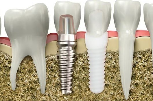 Long-Term Advantages of Choosing Dental Implants in Manchester The decision to invest in dental implants can be an impactful one, affecting an individual's life in a multitude of ways. One city that particularly stands out for its dental implant services is Manchester. Dental implants Manchester are not just a fleeting trend, but a long-term solution for those who want the best for their oral health. These implants are designed to last a lifetime, offering a plethora of benefits that make them an excellent choice. They provide a sturdy foundation for replacement teeth, which not only feel but look and function like natural teeth. Manchester's skilled dental professionals use state-of-the-art technology to ensure the implants are a perfect fit. Choosing dental implants in Manchester is, therefore, a worthwhile investment for anyone seeking a lasting solution to missing teeth. Introduction to Dental Implants Dental implants are a robust and reliable solution for replacing missing or damaged teeth. They consist of a titanium post that is surgically placed into the jawbone, providing a secure base for a crown or artificial tooth. The implant fuses with the bone over time, a process known as osseointegration. This fusion creates a strong and stable foundation, much like a natural tooth root, preventing the potential movement and slippage associated with traditional dentures. With a success rate of up to 98%, dental implants are increasingly becoming the first choice for tooth replacement. Furthermore, the dental professionals in Manchester offer unparalleled expertise in implantology, providing high-quality care and precision in every procedure. Durability and Longevity The durability and longevity of dental implants are among their most significant benefits, setting them apart from other tooth replacement options. Dental implants are designed to last a lifetime with proper care. Unlike dentures or bridges, which may require replacements or adjustments over time, the sturdy titanium implants provide a durable solution that withstands daily wear and tear. With the high-quality dental implant services in Manchester, you can rest assured that your implants will stand the test of time. Regular check-ups and good oral hygiene can help ensure your implants remain in excellent condition for years to come. So, for those seeking a long-lasting solution, it's worth considering dental implants in Manchester. Enhanced Aesthetic Appeal The aesthetic appeal of dental implants is undoubtedly another crucial factor contributing to their popularity. Dental implants look and feel like natural teeth, thanks to the seamless integration of the implant with the jawbone. This results in a natural-looking smile that can significantly enhance one's appearance. Additionally, dental implants prevent the facial sagging and premature ageing that can result from missing teeth, helping you maintain your youthful look. In Manchester, the dental professionals take great care in designing the prosthetic teeth, ensuring they blend in seamlessly with the rest of your teeth. With dental implants in Manchester, you can smile with confidence, knowing your teeth look natural and attractive. Improved Oral Health Dental implants also play a pivotal role in promoting overall oral health. They preserve the jawbone, preventing the bone loss that can occur when teeth are missing. Moreover, they don't require grinding down adjacent teeth as traditional bridges do, which helps protect your natural teeth. Dental implants also eliminate the need for removable dentures, allowing for easier eating and speaking. This contributes to improved digestion and communication, further enhancing quality of life. In Manchester, dental professionals adhere to the highest standards of sanitation and hygiene during the implant procedures, minimising the risk of infection. Opting for dental implants in Manchester is a step towards improved oral health and a healthier lifestyle overall. Boosted Confidence and Self-Esteem A bright, healthy smile can do wonders for one's confidence and self-esteem, and dental implants play a significant role in achieving this. Dental implants in Manchester offer a sense of security and comfort, as they don't slip or move around like traditional dentures can. This stability allows for clear speech and the freedom to enjoy all types of food without worry, which can greatly enhance one's social experience and self-confidence. The implants also provide a natural look and feel, offering an attractive smile that elevates self-esteem. For many, dental implants in Manchester have been a life-changing investment, transforming not only their smiles but also their overall confidence. Cost-Effectiveness in the Long Run While the initial cost of dental implants may be higher than other tooth replacement options, they prove to be cost-effective in the long run. The durability of dental implants reduces the need for replacements or adjustments, saving you significant expenses over the years. Additionally, dental implants prevent potential oral health issues associated with missing teeth, such as bone loss and shifting teeth, which could result in pricey dental procedures down the line. The dental professionals in Manchester offer affordable, high-quality dental implant services, bringing this long-term solution within reach of more people. Thus, choosing dental implants in Manchester is a wise investment for your oral health and financial future. Conclusion In conclusion, dental implants offer a sustainable, long-term solution for tooth replacement, providing numerous benefits such as durability, aesthetic appeal, improved oral health, boosted confidence, and cost-effectiveness. Choosing dental implants in Manchester ensures access to high-quality care from skilled dental professionals using state-of-the-art technology. While the initial investment may be considerable, the long-term advantages make it a worthwhile choice. So, whether you're seeking to enhance your smile, improve your oral health, or boost your confidence, dental implants in Manchester can provide a lasting solution.